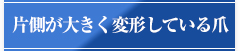 片側が大きく変形している爪